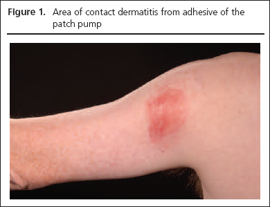 Topical steroids withdrawal treatment
